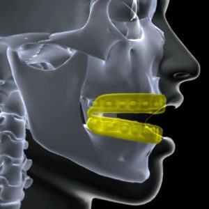 best mouthguard for children with braces