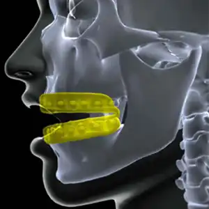 braces sports mouthguard